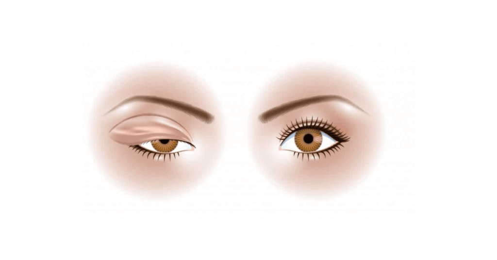 10 Facts About Blepharoplasty