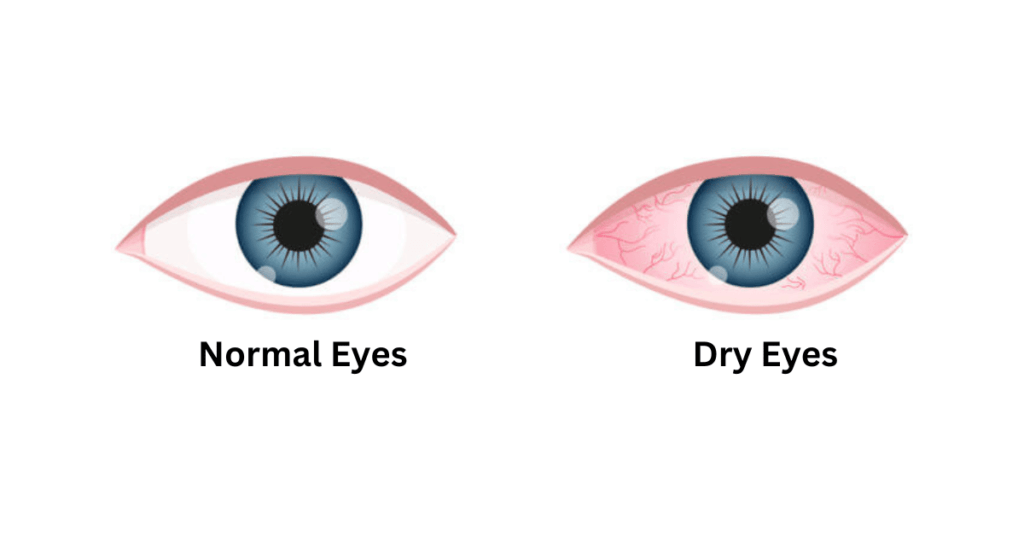 Dry Eyes: Factors, Treatment, and Preventing