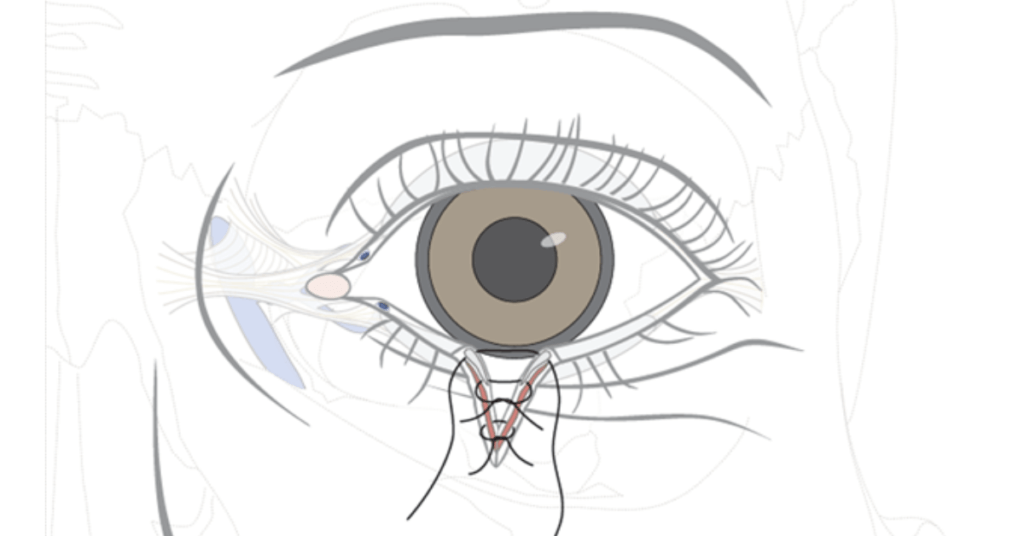 Eyelid Laceration Treatment in India