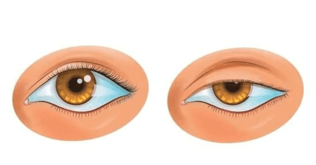 Ptosis eye surgery for clear vision and better appearance