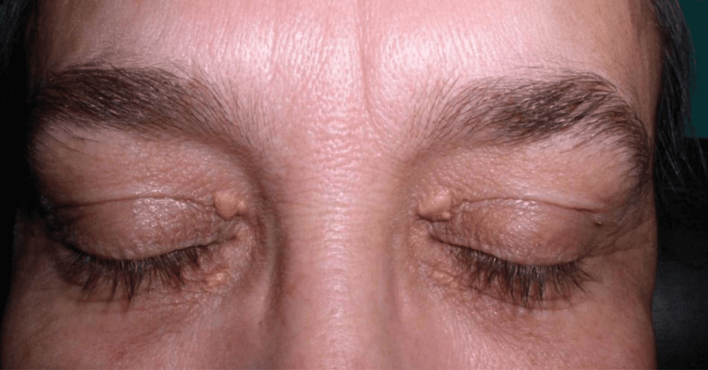 Surgical and Non-Surgical Approaches to Xanthelasma Removal