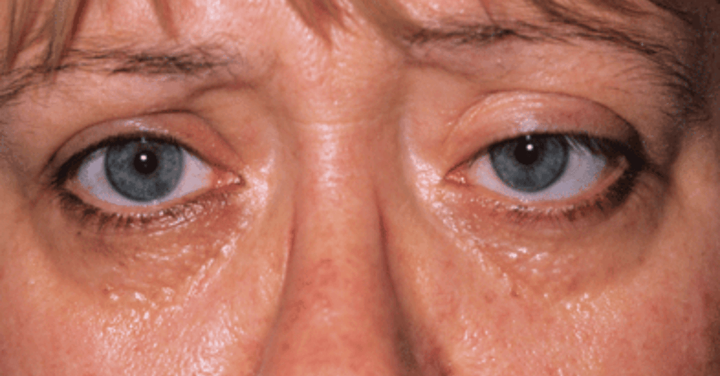 The Signs of Thyroid Eye Disease and its Cure