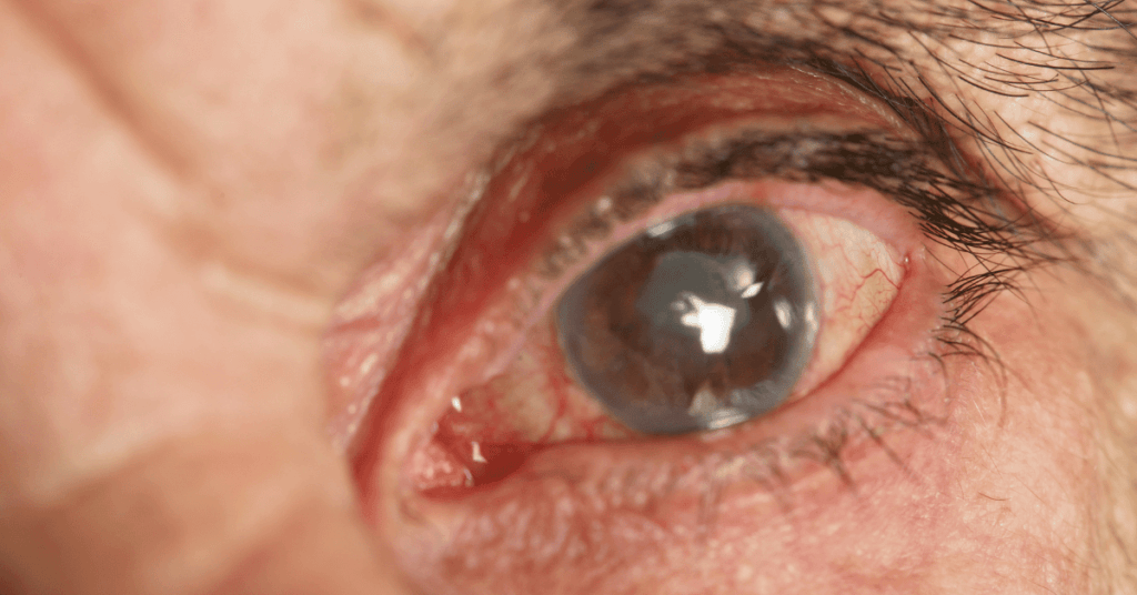 Early Detection of Glaucoma