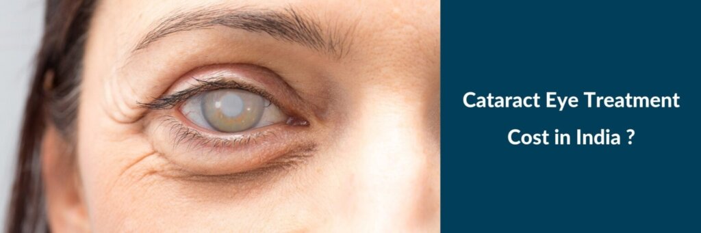 How Much Does Cataract Surgery Cost in India