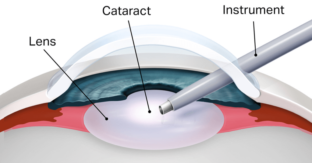 How Cataract Surgery Works