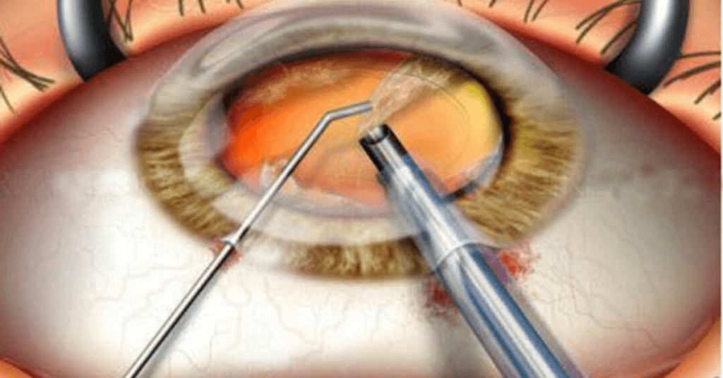 cataract surgery cost in mumbai