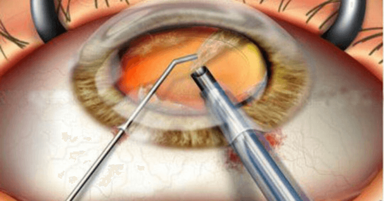 Cataract Surgery Cost in Mumbai | Affordable Motiyabind Operation